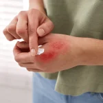 Mujer resulta gravemente herida tras ataque en Haina; agresor le mutila parte de la nariz