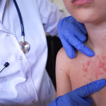 Panamá supera los 7 millones de dosis aplicadas contra el sarampión